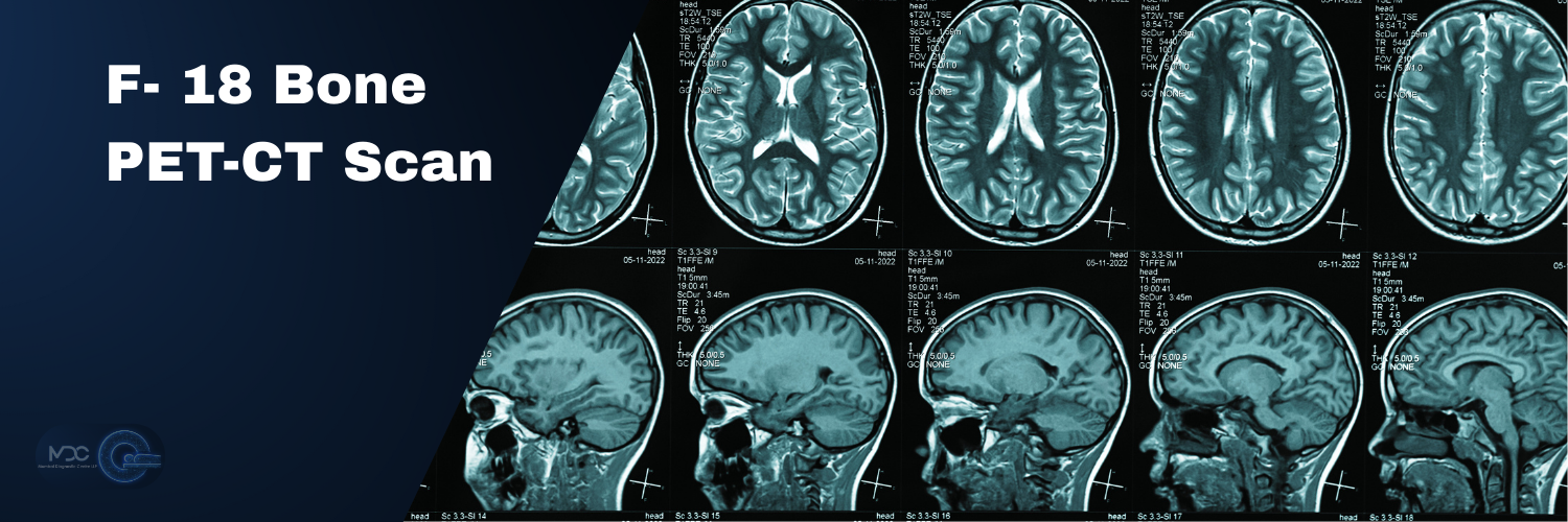 F- 18 Bone PET-CT SCAN