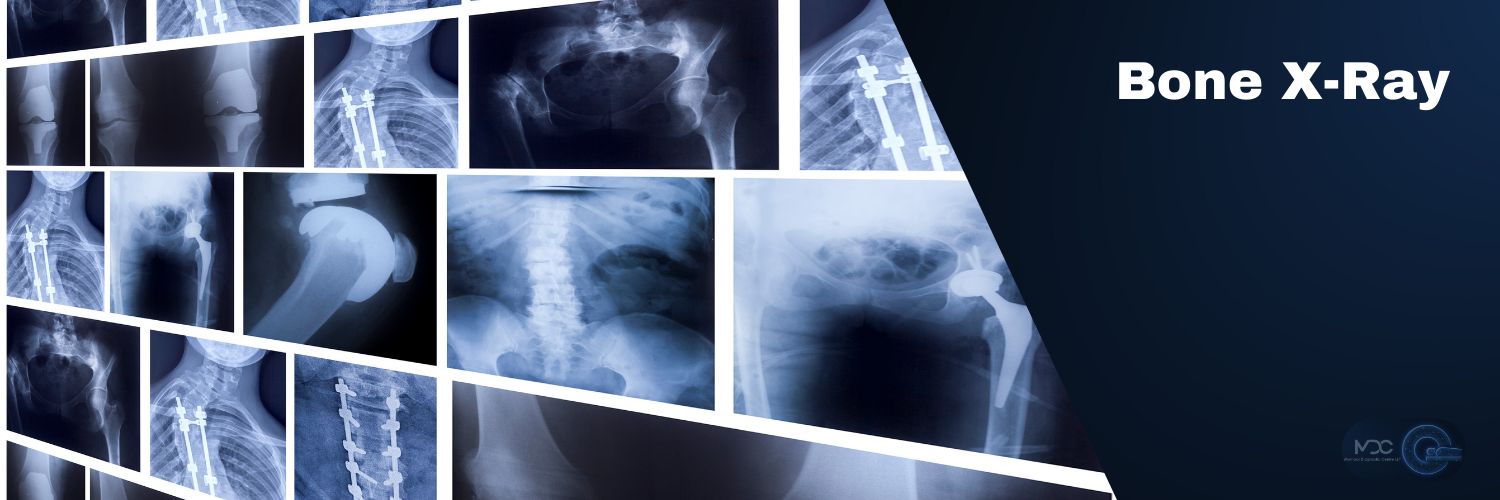 Bone X-Ray