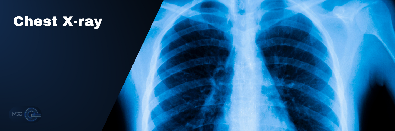 Chest X-Ray