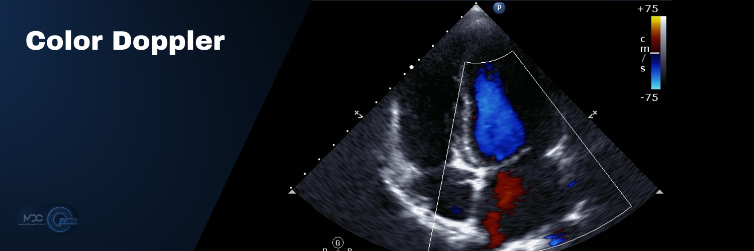 Color Doppler